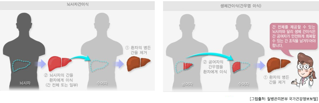 뇌사자 및 생체 간이식