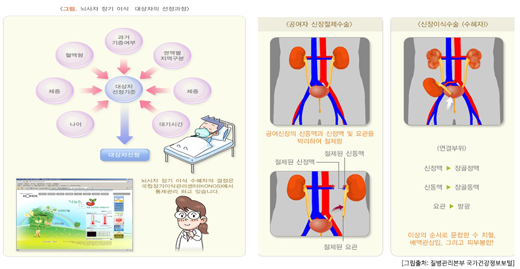 신장이식