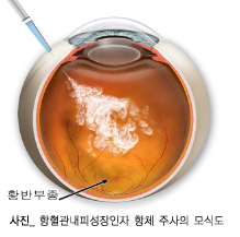 황반변성