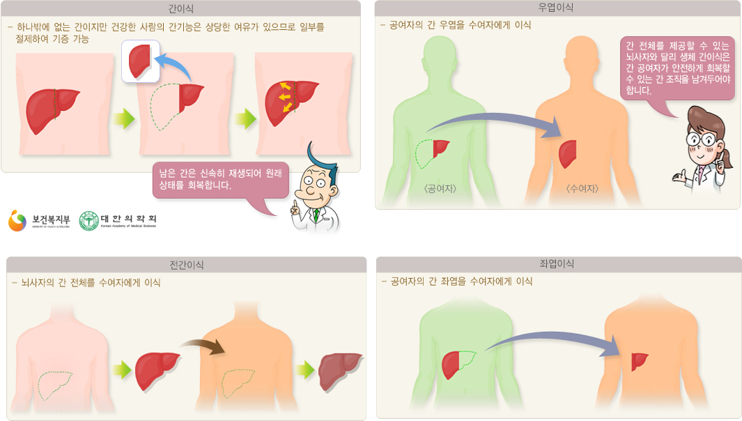 간이식 : 하나밖에 없는 간이지만 건강한 사람의 간기능은 상당한 여유가 있으므로 일부를 절제하여 기증 가능. 남은 간은 신속히 재생되어 원래 상태를 회복합니다. 우엽이식 : 공여자의 간 우엽을 수여자에게 이식. 간 전체를 제공할 수 있는 뇌사자와 달리 생체 간이식은 간 공여자가 안전하게 회복할 수 있는 간 조직을 남겨두어야 합니다. 전간이식 : 뇌사자의 간 전체를 수여자에게 이식. 좌엽이식 : 공여자의 간 좌엽을 수여자에게 이식.