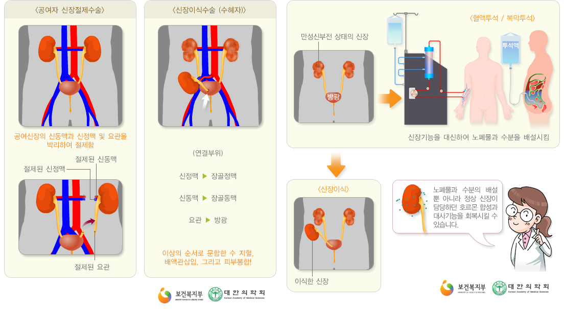 공여자 신장절제수술. 공여신장의 신동맥과 신정맥 및 요관을 박리하여 절제함. 절제된 신정맥, 절제된 신동맥, 절제된 요관. 신장이식 수술(수혜자) (연결부위) 신정맥에서 장골정맥, 신동맥에서 장골동맥, 요관에서 방광. 이상의 순서로 문합한 수 지혈, 배액관삽입, 그리고 피부 봉합! 만성신부전 상태의 신장. 혈액투석/복막투석. 신장기능을 대신하여 노폐물과 수분을 배설시킴. 신장이식. 이식한 신장. 노폐물과 수분의 배설 뿐 아니라 정상 신장이 담당하던 호르몬 합성과 대사기능을 회복시킬 수 있습니다.