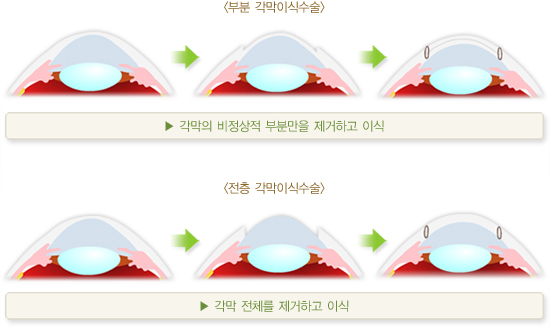 부분 각막이식수술. 각막의 비정상적 부분만을 제거하고 이식. 전층 각막이식수술. 각막 전체를 제거하고 이식.