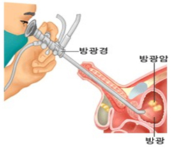 방광경 검사 참고 사진 - 방광경, 방광암, 방광