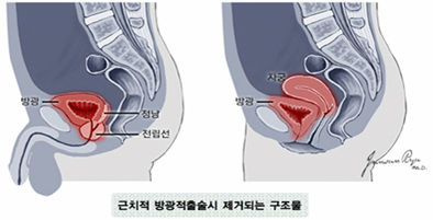 근치적 방광적출술시 제거되는 구조물