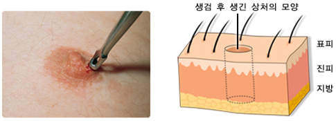 펀치 생검 참고 사진. 생검 후 생긴 상처의 모양. 표피 진피 지방